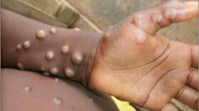 Infections of monkeypox in the world have increased by 20 .