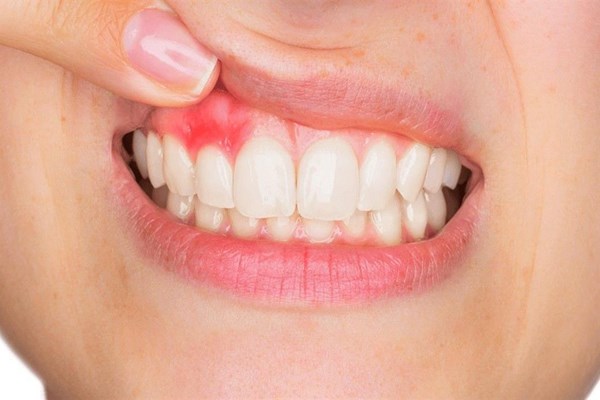 What are the causes of gingivitis and how to prevent it?