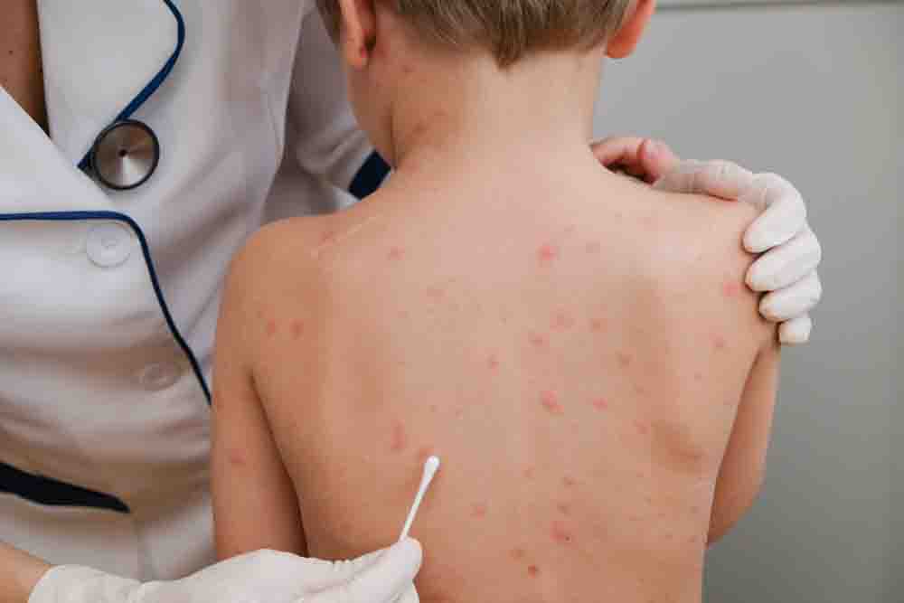 Monkeypox cases in the United States exceed 26,000 confirmed cases