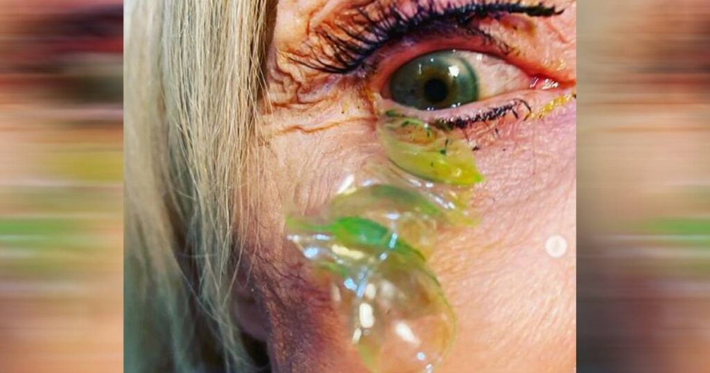 US woman had 23 contact lenses in her eye for nearly a month