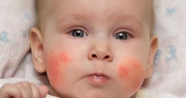 Know the reasons for your child’s suffering from the rash and methods of treatment