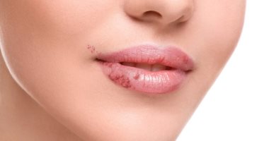 What are the symptoms of herpes infection? .. Oral ulcers are the most prominent