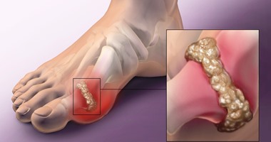 The high blood acid in the blood exposes you to gout .. 4 tips for prevention