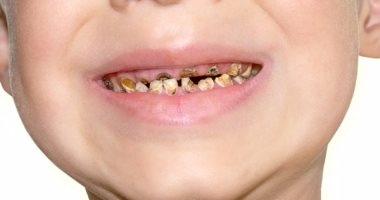 How to protect your child’s teeth from decay?