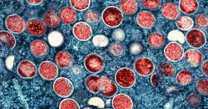 Monkeypox Infections ‘Steadily Decreating’ in Canada, Phac Declares