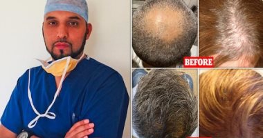 A British surgeon reveals Corona’s relationship with increasing hair loss and resorting to modern treatment techniques