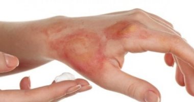 5 advice for first aid for different burns and wounds