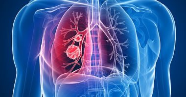 Are you at risk of lung cancer if your family suffers from the disease?