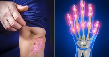 Various types of psoriasis arthritis and factors that increase the risk of infection