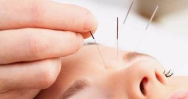 All you want to know about Chinese acupuncture