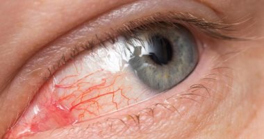 How do you avoid the spread of pink eye infection in your home?